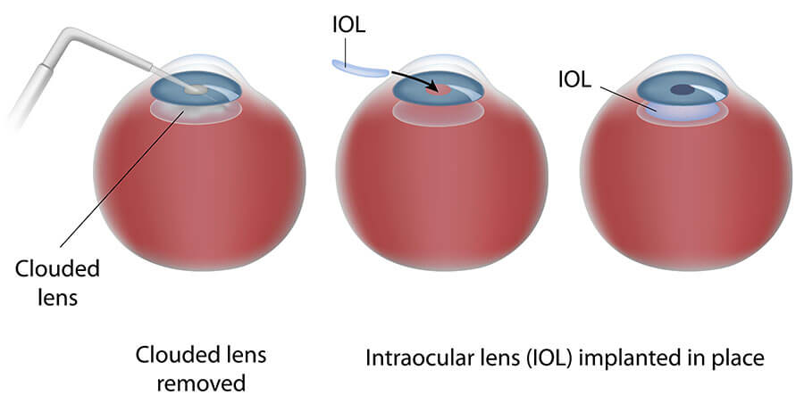 Chart Showing the Cataract Surgery Process