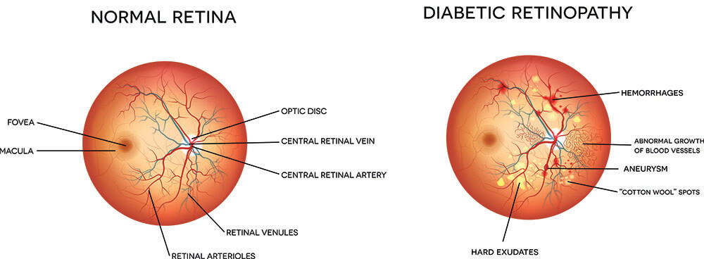 Chart Showing a Healthy Eye Compared to One With Diabetic Retinopathy
