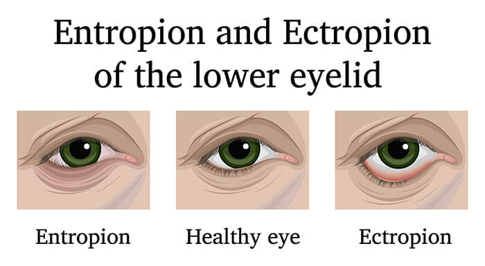 Entropion and Ectropion of the Lower Eyelid - Chart Illustrating How Entropion, Extropion and a Healthy Eye Looks