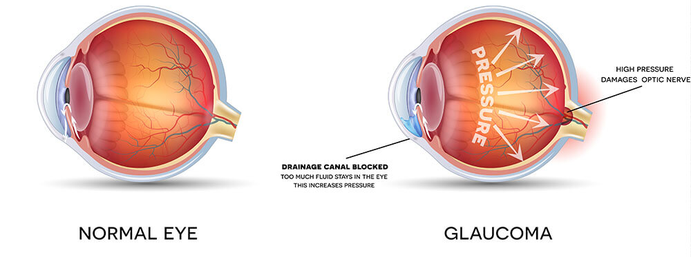 Chart Showing How Glaucoma Affects the Eye