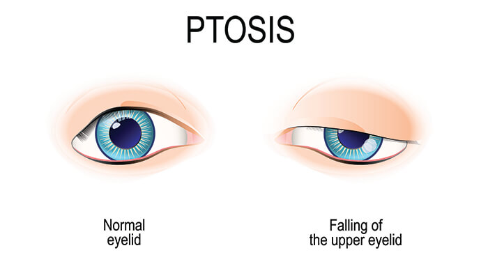Chart Showing How Ptosis Affects an Eye